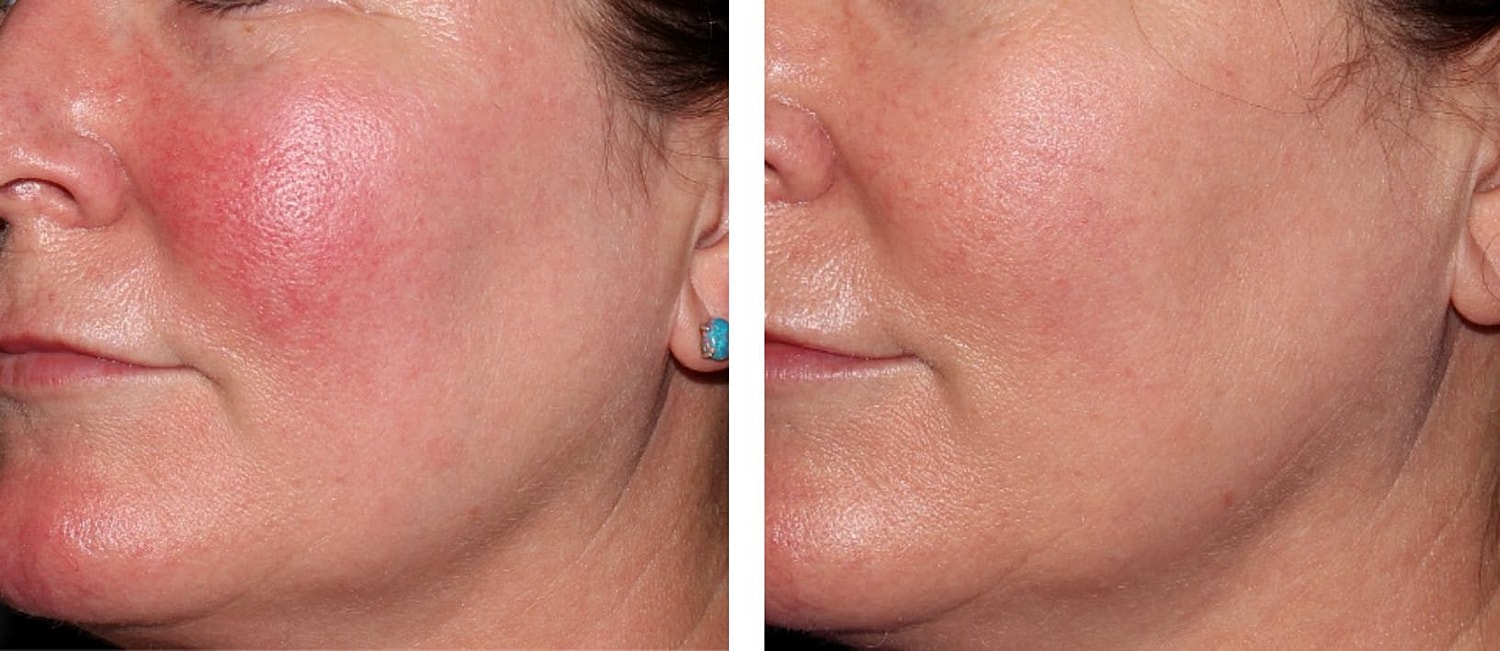 Before and after skin treatment comparison on woman.
