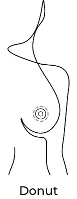 Anchor breast procedure illustration.