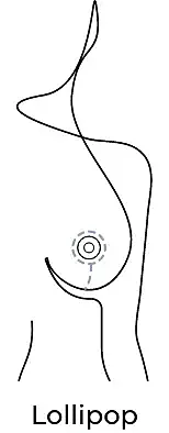 Anchor breast procedure illustration.