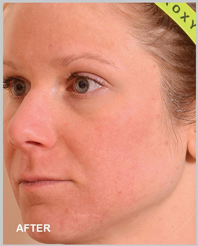 Skin improvement after treatment, side profile view.