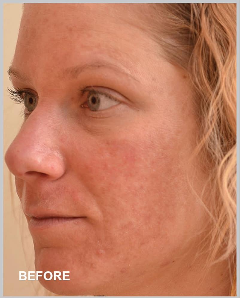 Woman's skin condition before treatment.