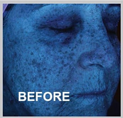 Skin condition analysis under ultraviolet light, before treatment.