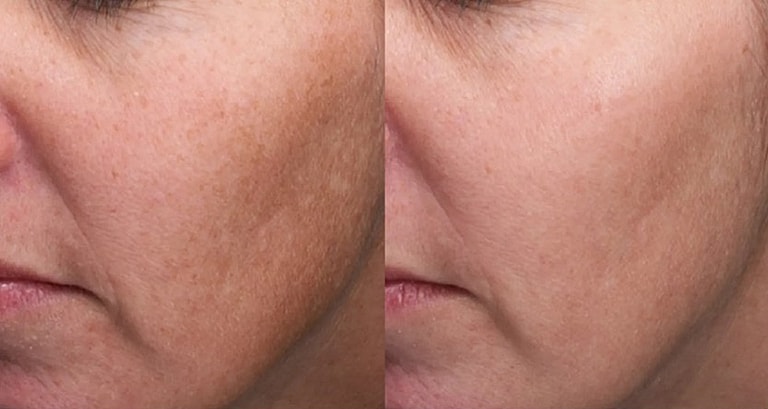 Side-by-side comparison of skin texture improvement.
