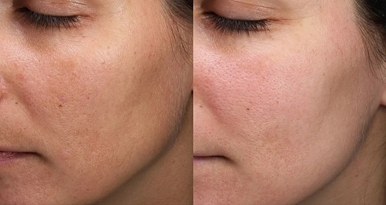 Before and after skin texture improvement comparison.