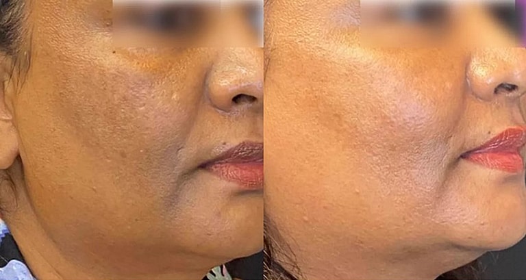 Before and after skincare treatment comparison.